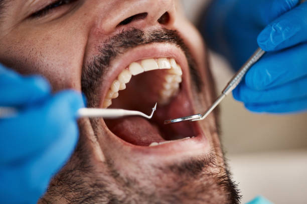 Best Emergency Wisdom Teeth Removal in River Ridge, LA